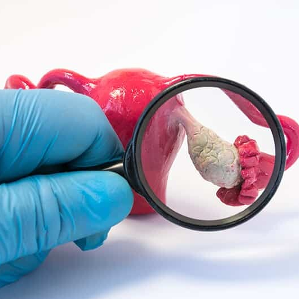 Yumurtalık Kistleri (Endometrioma ve İyi Huylu Kistler)